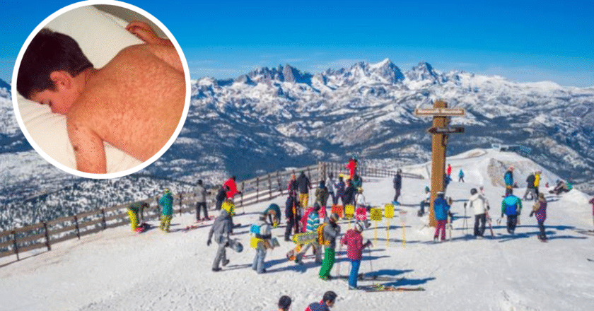 Masern Skigebiet Österreich: Warum dein Winterurlaub ein Gesundheitsrisiko sein kann
